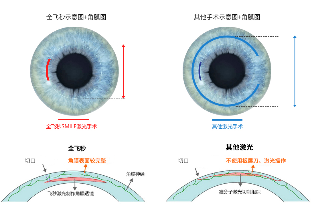 近视手术方式对比